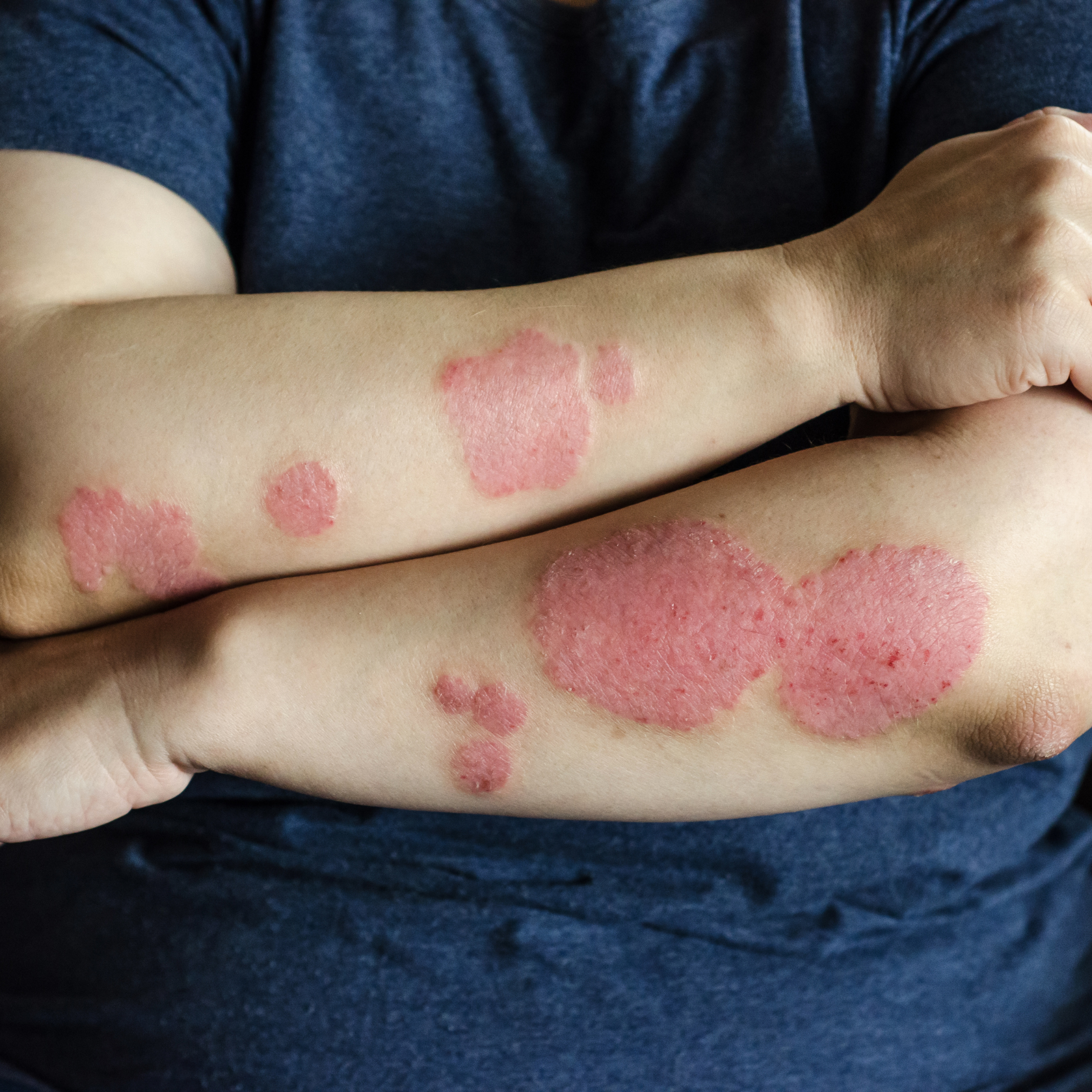 skin lesions patches