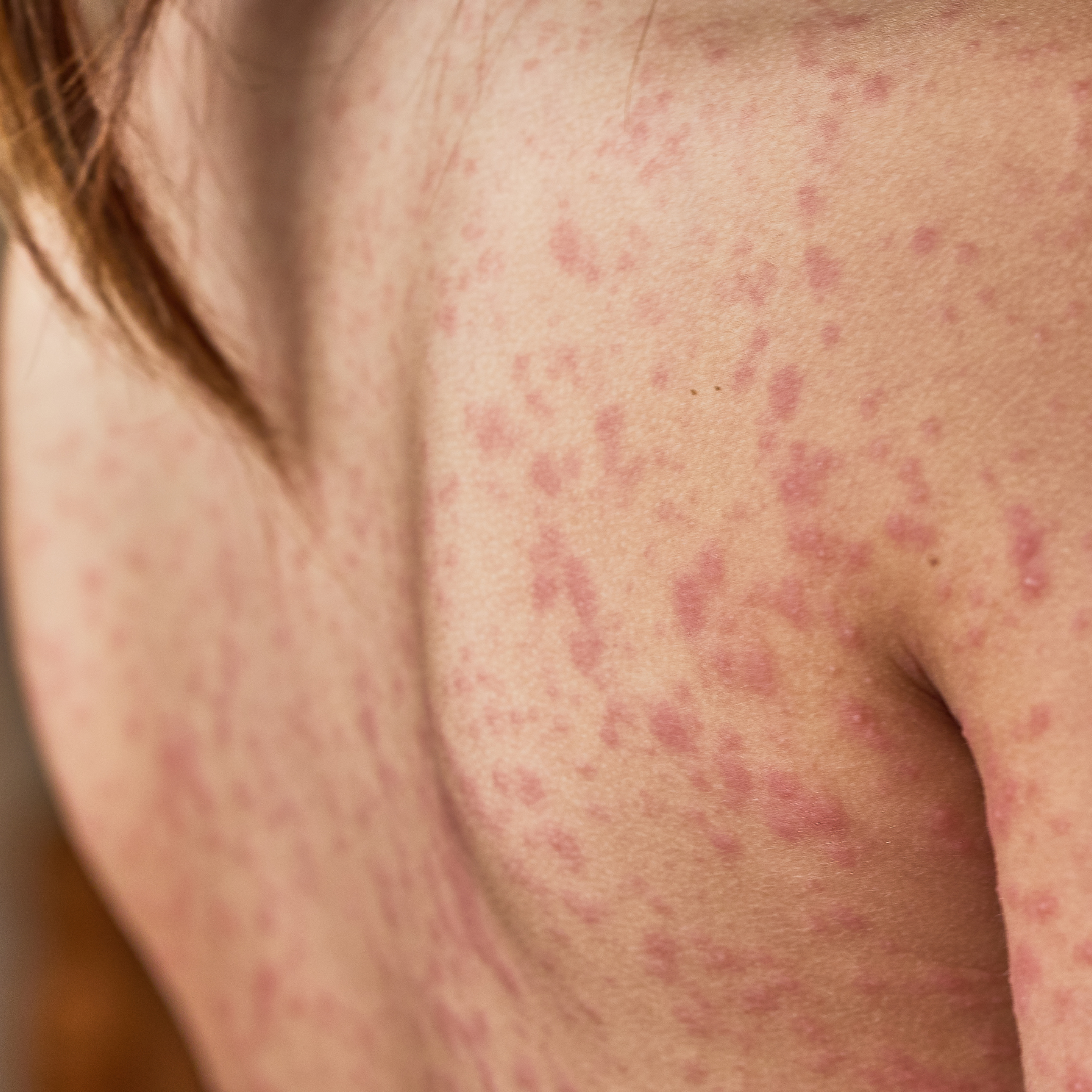 skin rash